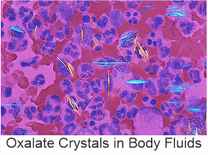 Oxalate Crystals in Body Fluids