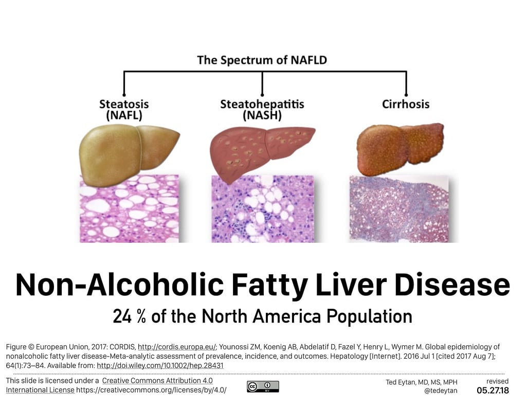 Fatty Liver Chart