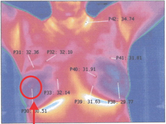 Breast Thermography Scan